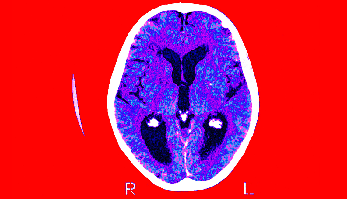 Exploración de un cerebro con la enfermedad de Alzheimer