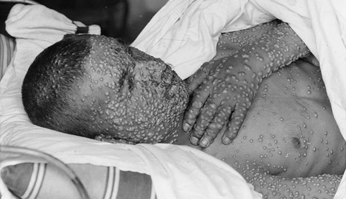Smallpox victim, Plagues and Epidemics Through the Ages,