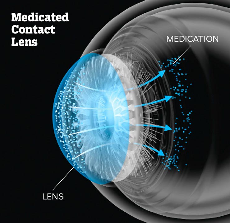Lente de contacto en un ojo - Fin a la pérdida de visión en el futuro