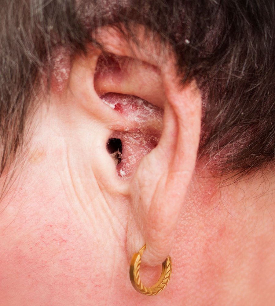 psoriasis in ear canal tinnitus
