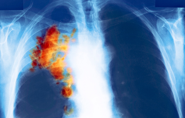 A chest x-ray with tumor in lungs