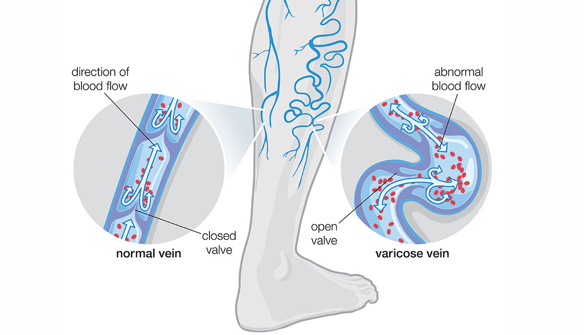 Diagram illustrating varicose veins