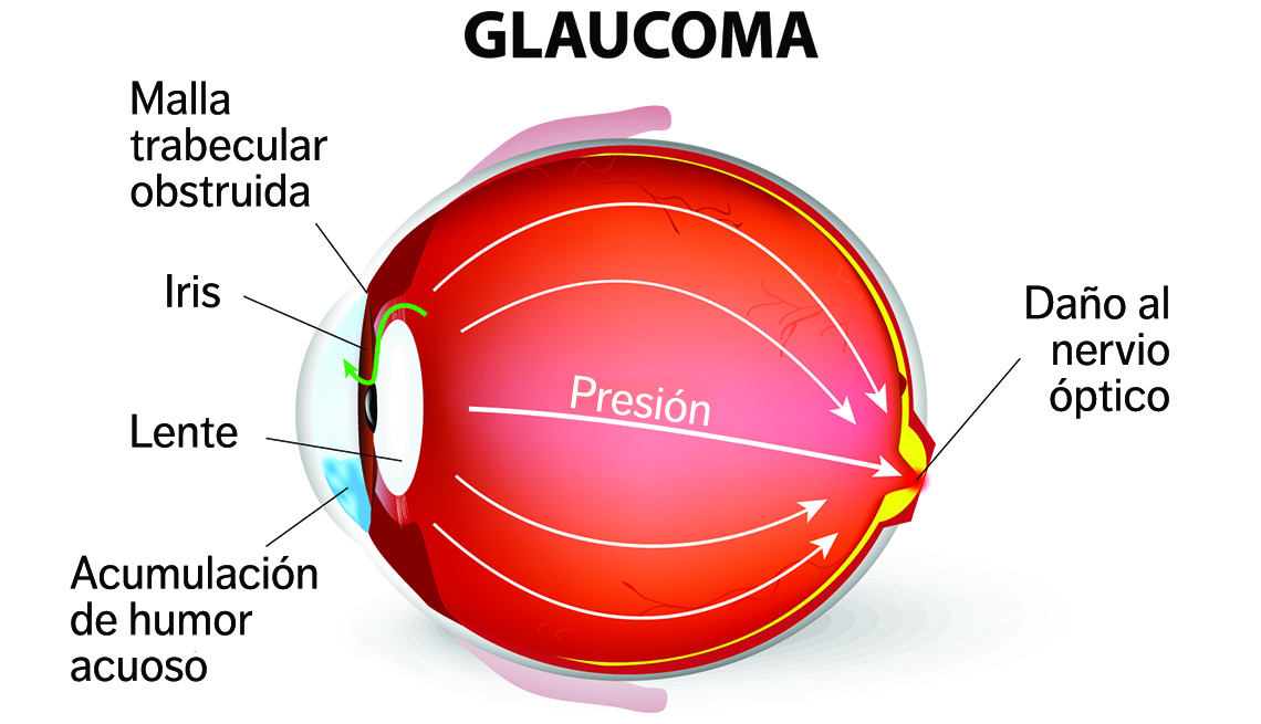 Ilustración de un ojo que padece de glaucoma