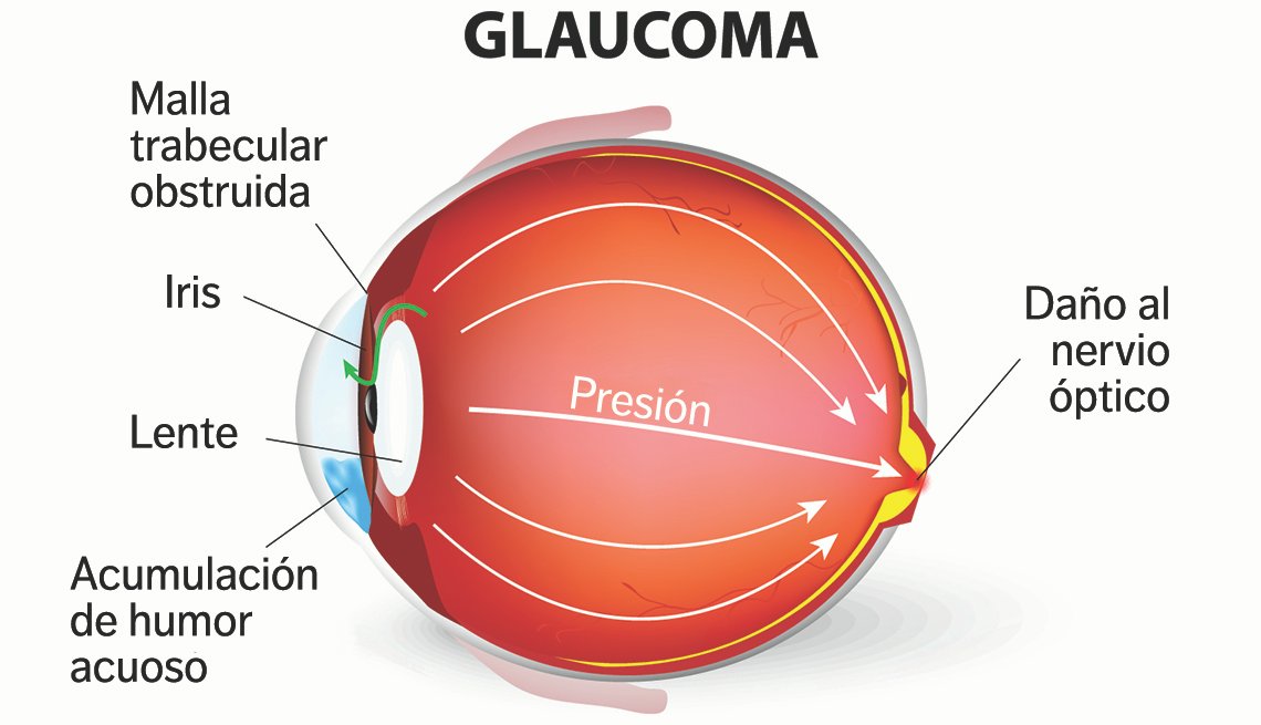 Conoce más sobre el glaucoma y cómo tratarlo