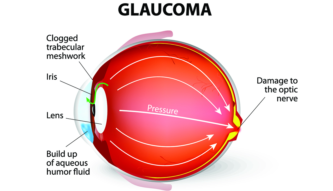 Glaucoma infographic