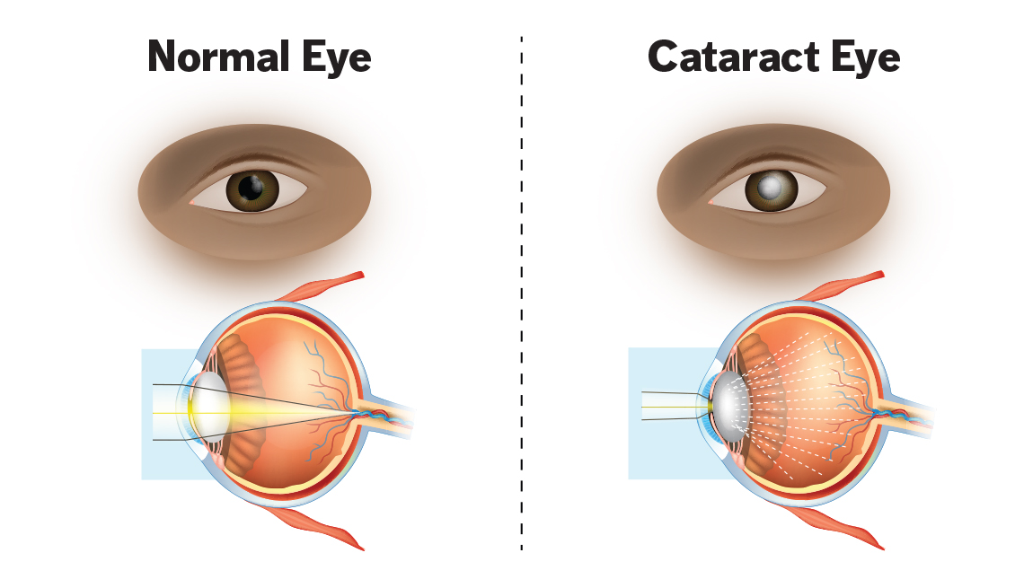 Normal eye vs cataract eye