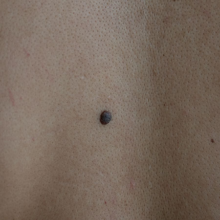 example of melanocytic nevi (moles) on a person's back 
