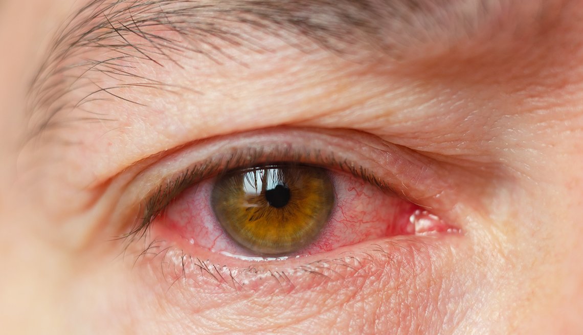 Covid Symptoms In Babies Red Eyes