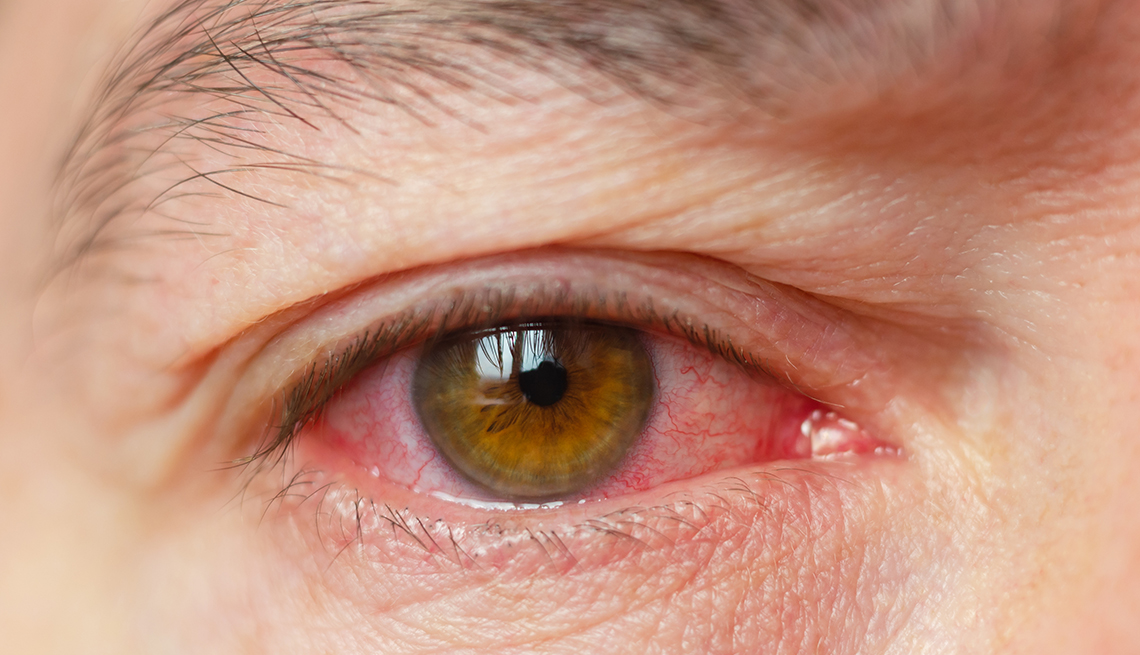 A closeup of someone infected with pink eye
