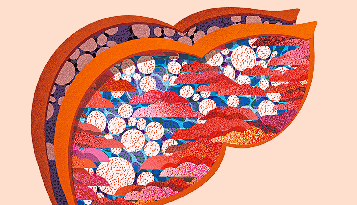 Ilustración de un hígado graso