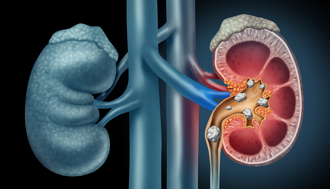 human kidney stones medical concept
