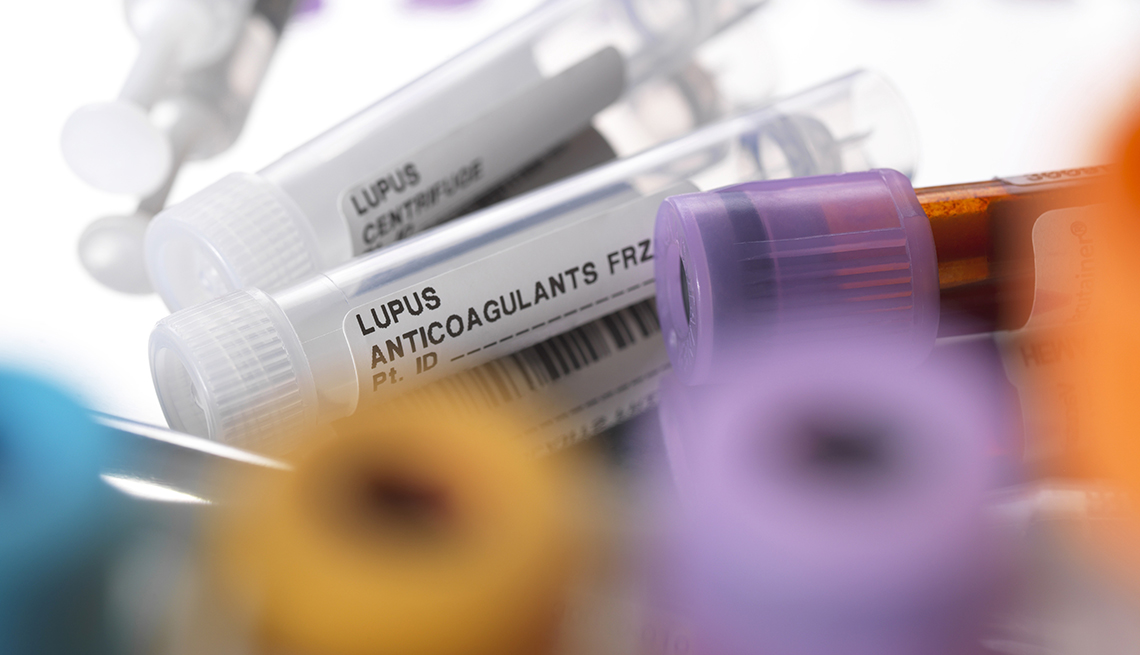 Tubos con anticoagulantes contra el lupus y muestra de sangre
