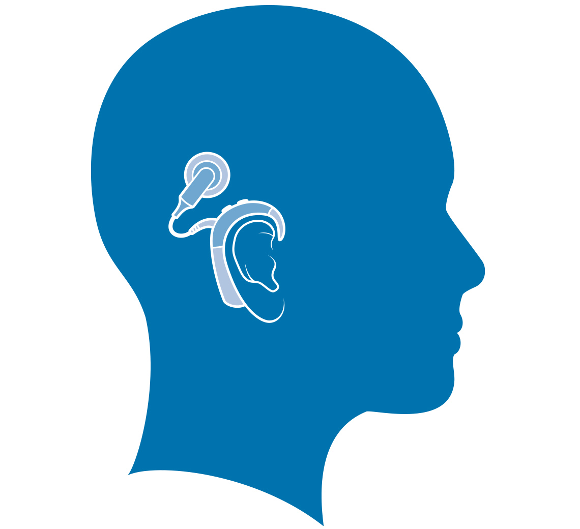 an illustration of a cochlear implant in the human ear