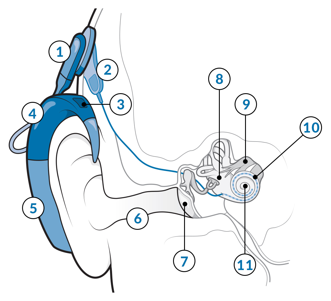 an illustration of a cochlear implant in the human ear with numbers marking the parts of the ear and implant