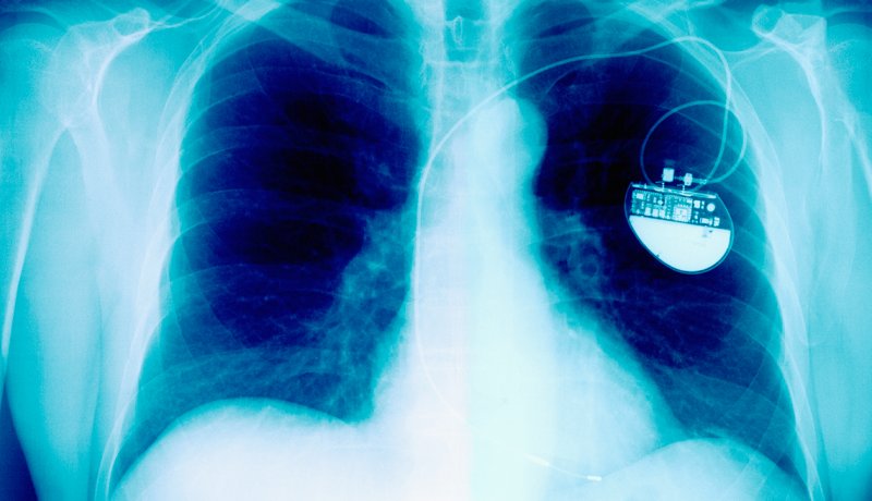 Radiografía de una persona con un marcapaso