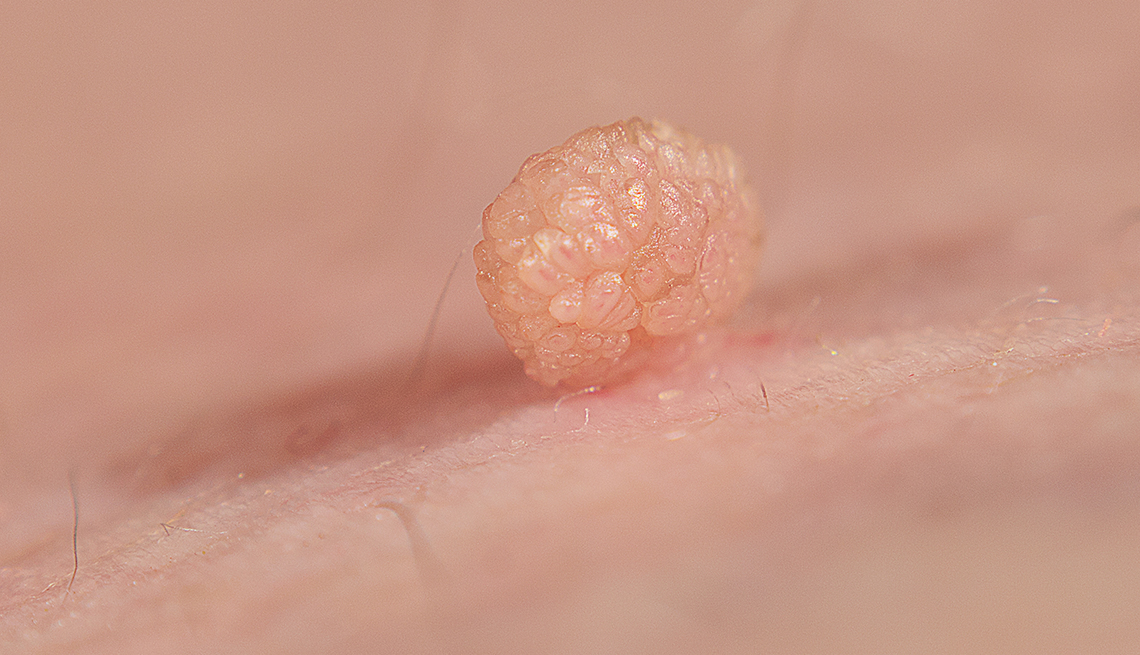 close up of a skin tag or acrochondon