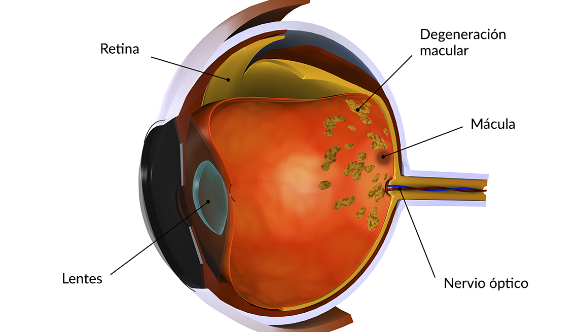 Ilustración de un ojo con degeneración macular
