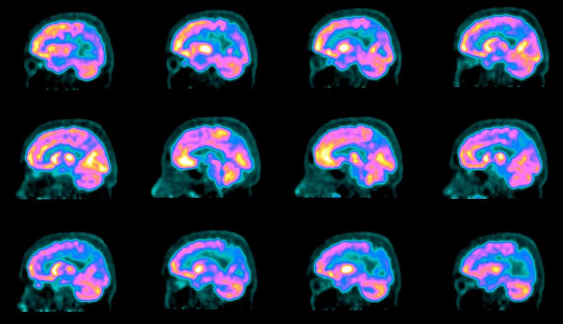 Escáner de un cerebro con Alzheimer