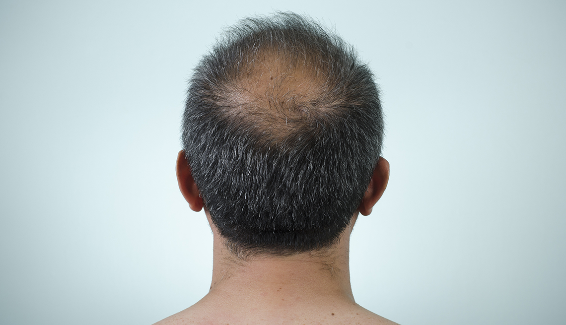 Parte trasera de la cabeza donde se aprecia un área con caída de cabello. 