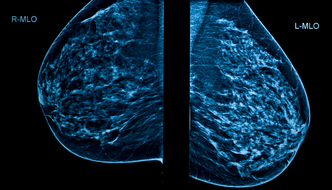Mammograms When And How Often Should Women Get Them?