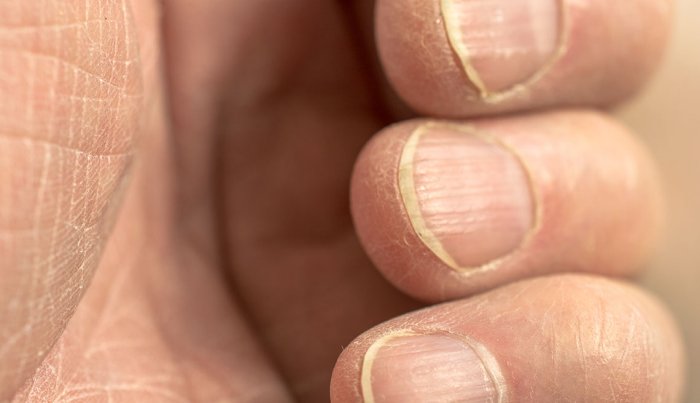 Uñas amarillentas Uñas amarillentas