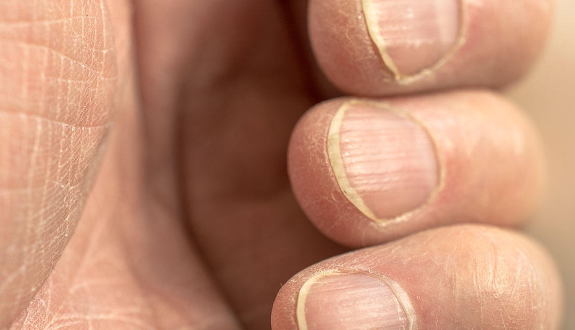 Qué son las manchas blancas en las uñas