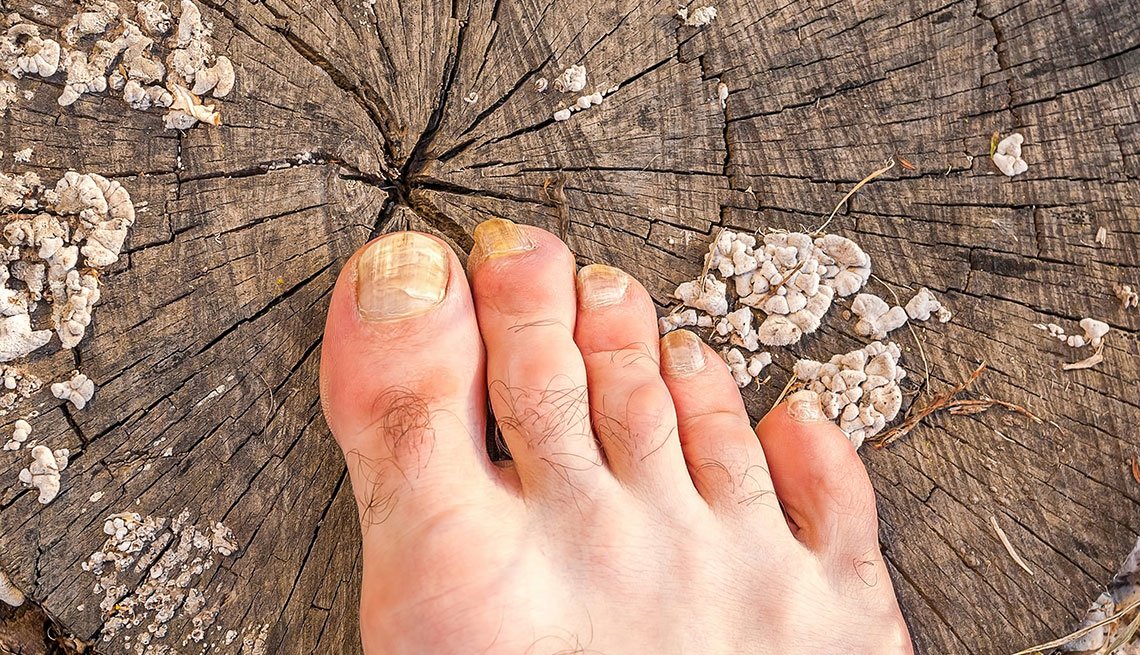 Why Do My Big Toenails Have Vertical Ridges Bios Pics