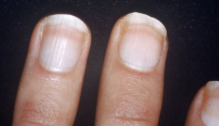 Uñas blancas Uñas blancas