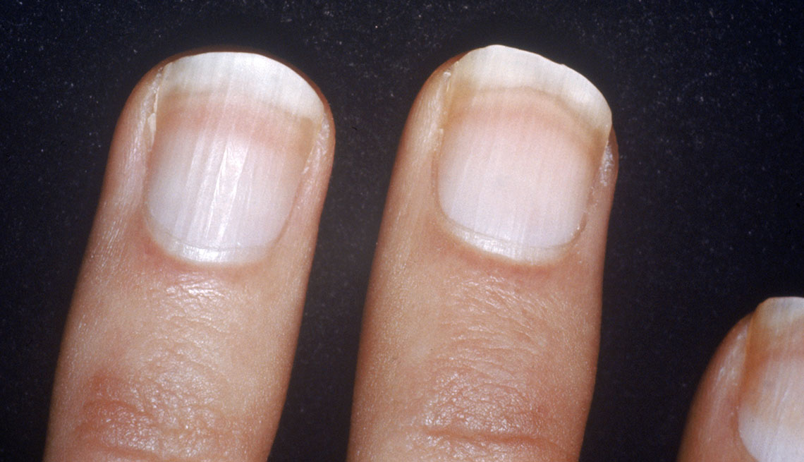 What Are Your Nails Saying About Your Health 