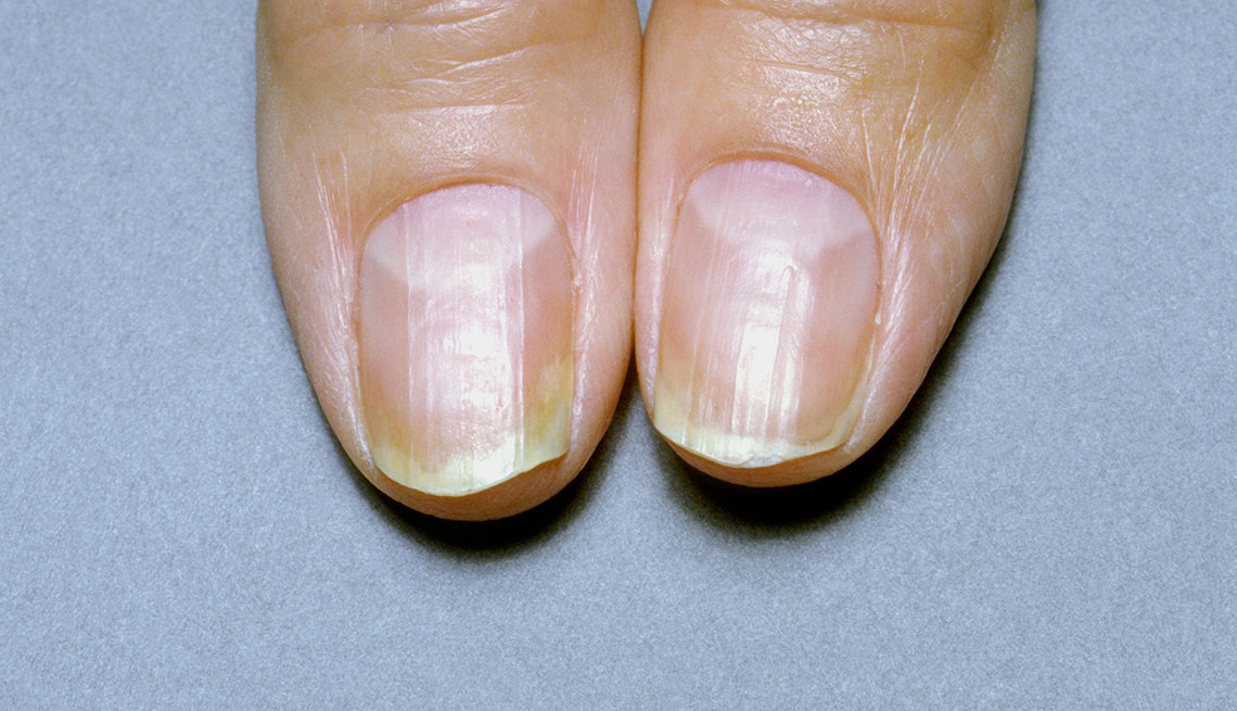 Dermapixel El misterio de las uñas blancas