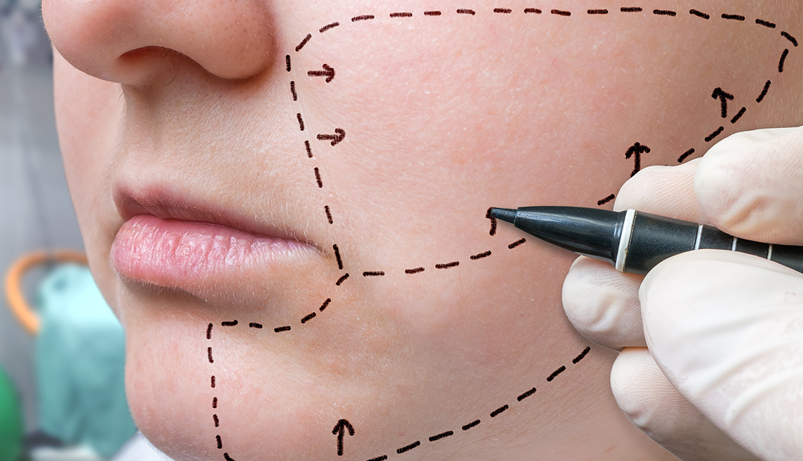 Imagen de una liposucción de cuello y cara, como método para mejorar su apariencia.