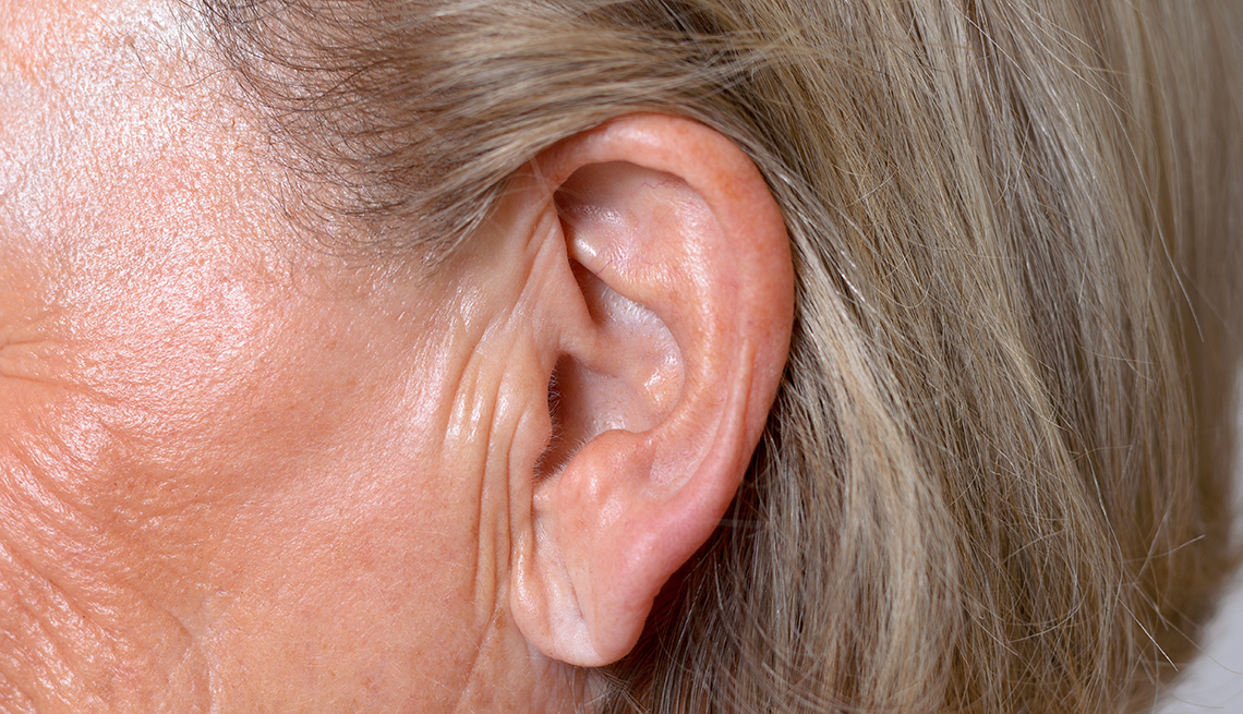Ear Lobe Crease May be Sign of Stroke Risk 