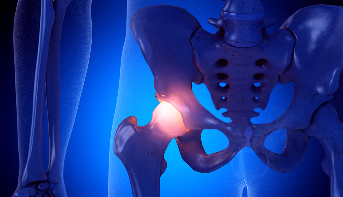 Ilustración médica de una cadera con una coyuntura inflamada