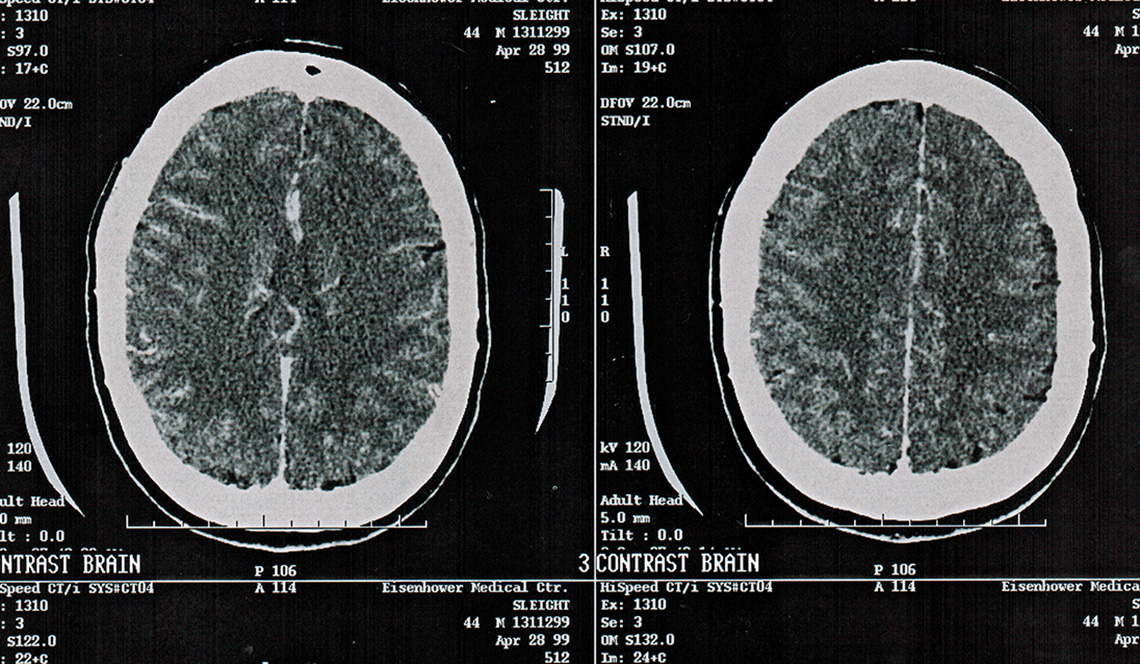 black and white image of brain cancer scan