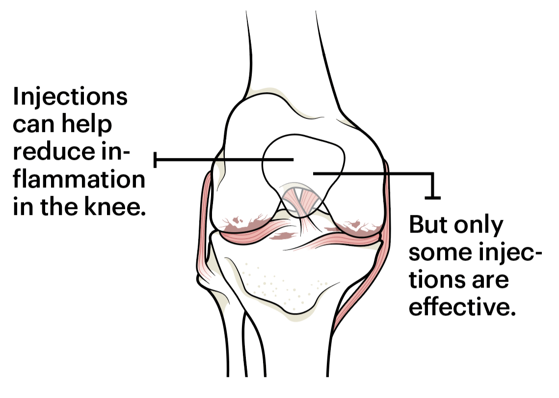 Illustration of a knee bone