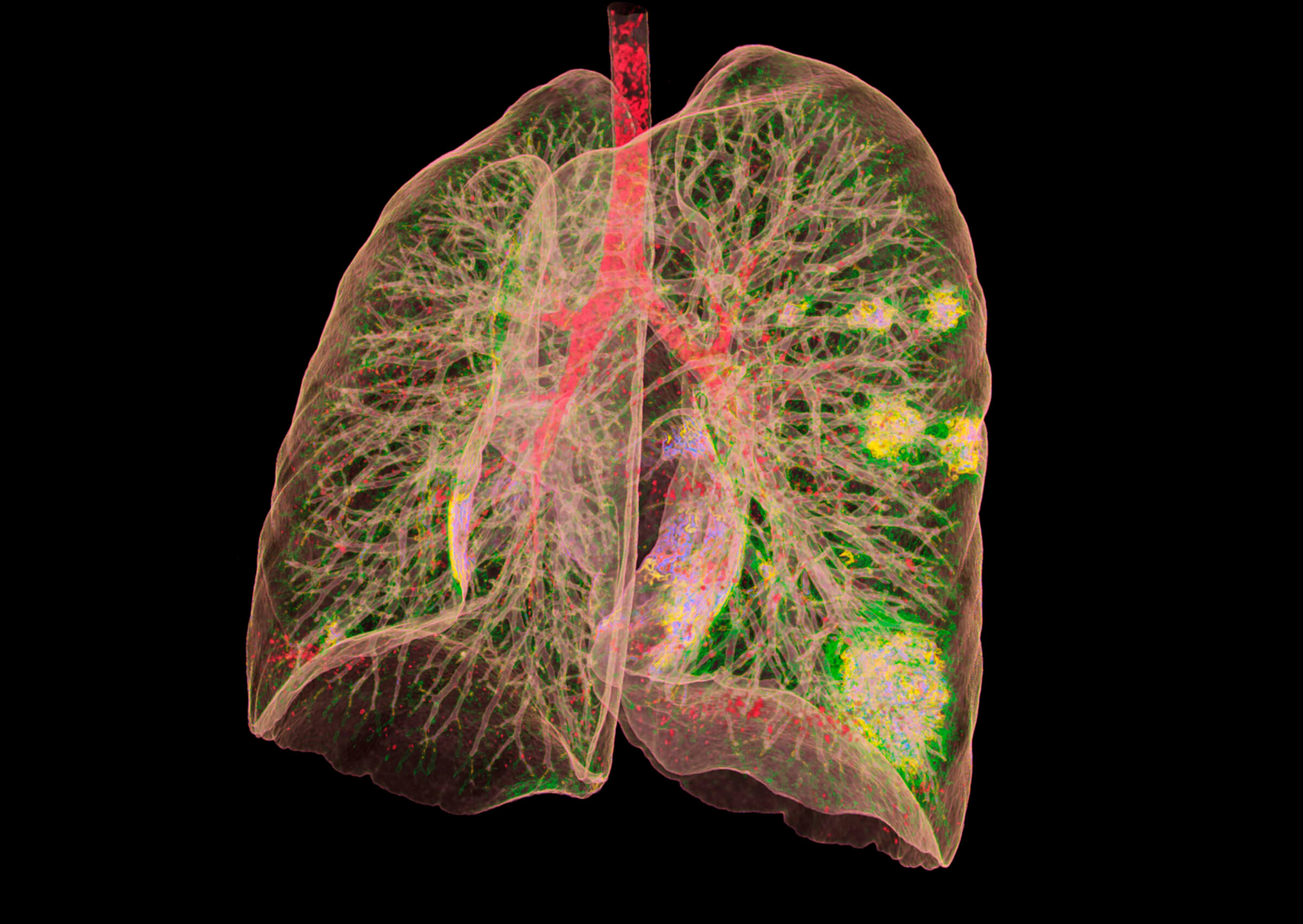 Medical illustration of a lung with pneumonia