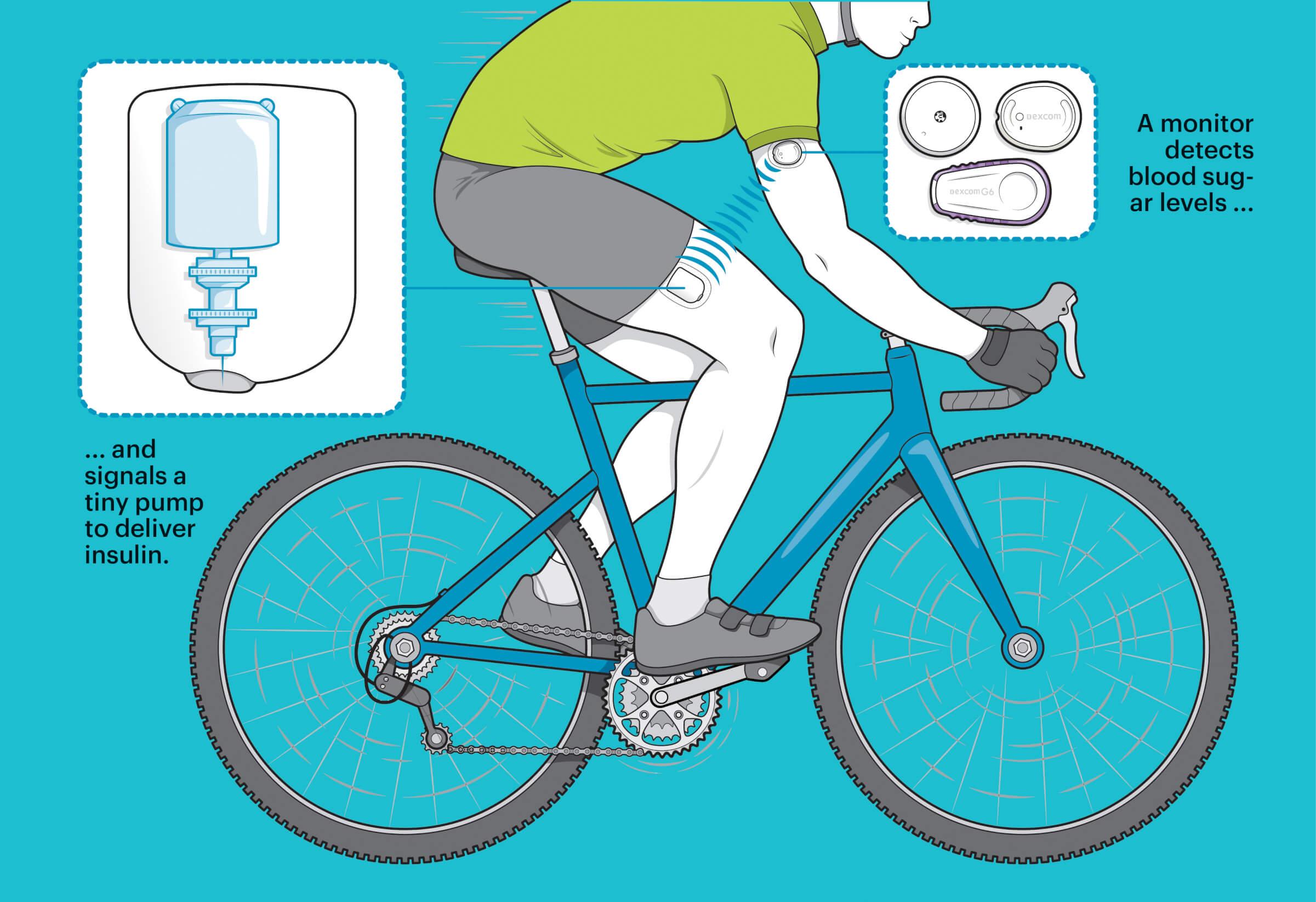Illustration of a man on a cycle. He is wearing a small circular device on his arm and on his thigh. There are little blue lines that looks like the device on the arm and thighs are connected. One arrow points to his arm and they text says, A monitor detects blood sugar levels and signals a tiny pump to deliver insulin.
