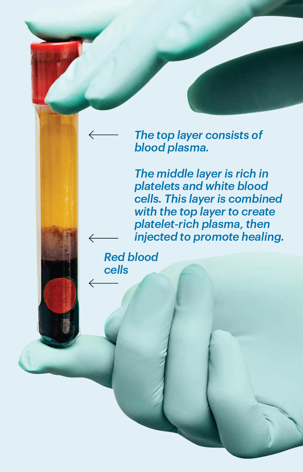 Image of gloves holding up a test tube showing the different layers of spun blood: a bottom layer of red blood cells, a middle layer of platelets and white blood cells, and a top layer of yellow blood plasma.