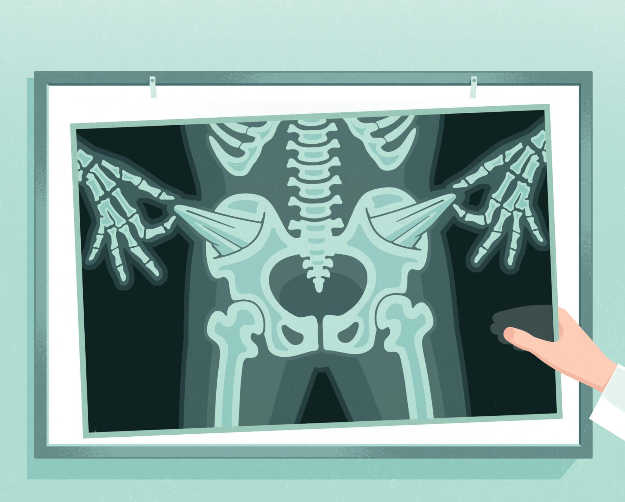 Illustration of a scan of a person’s hip. In the scan the person’s hands are pulling out their pockets which are empty, representing that they’re out of money