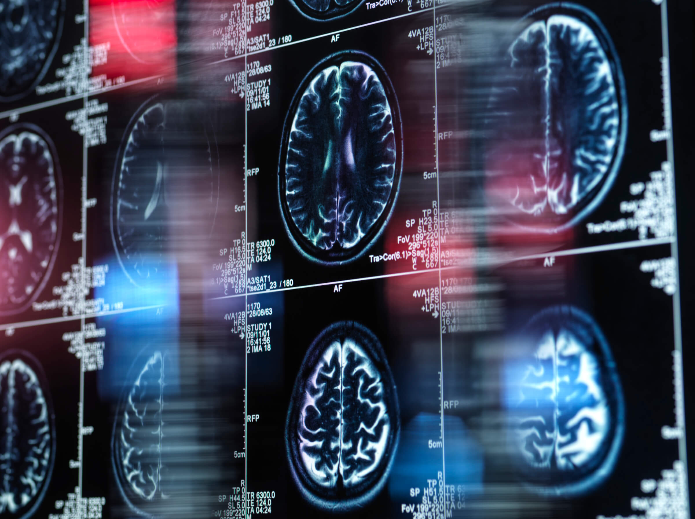 Magnetic resonance imaging (MRI) scan of a human brain on a screen