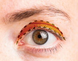 Photo illustrating upper-lid blepharoplasy of an eye