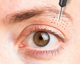 Photo illustrating nonsurgical eyelid lift of an eye