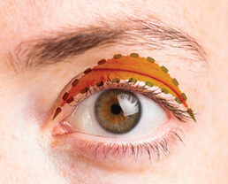 Photo illustrating ptosis repair of an eye