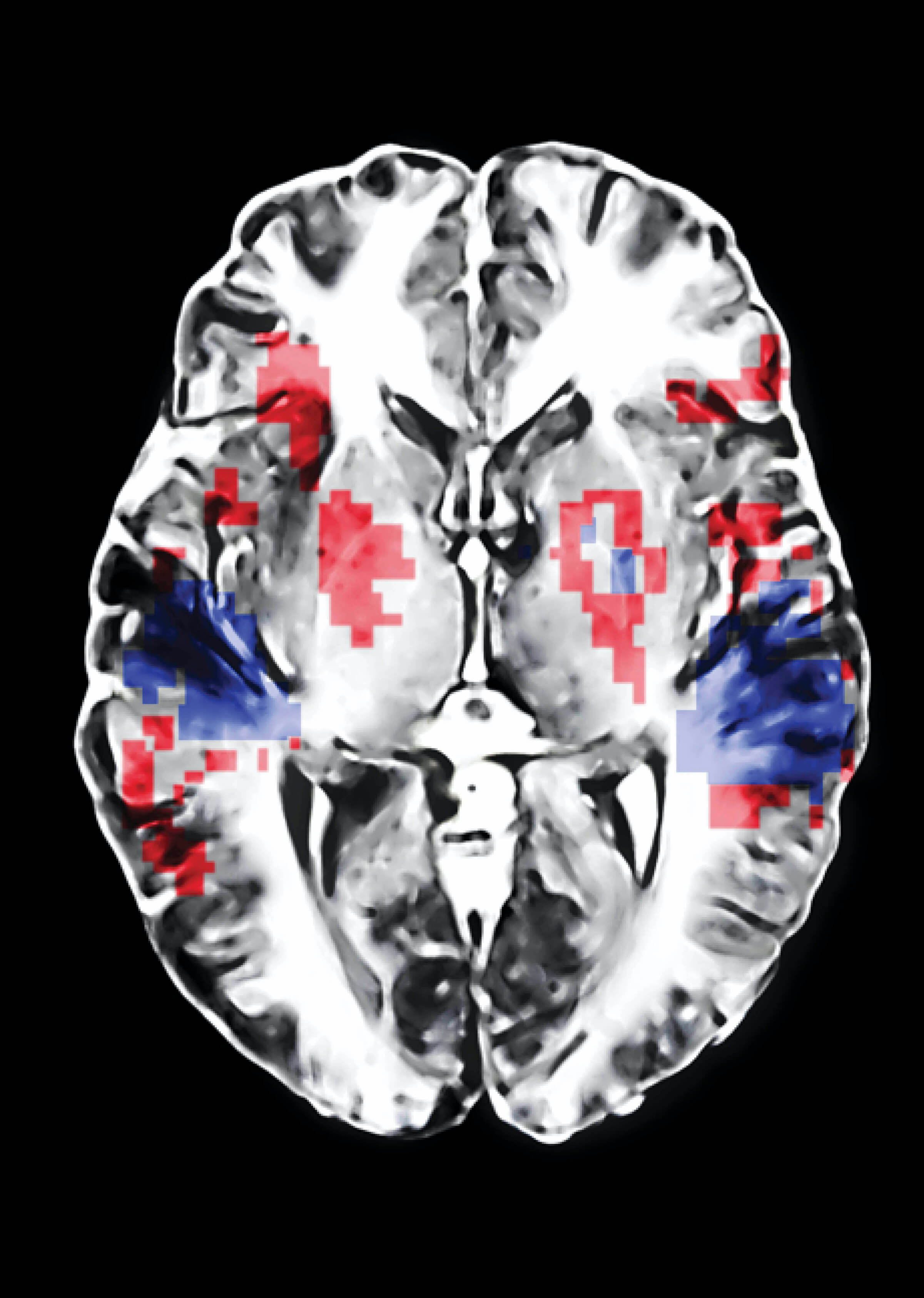 Photo of a brain scan showing areas stimulated by music