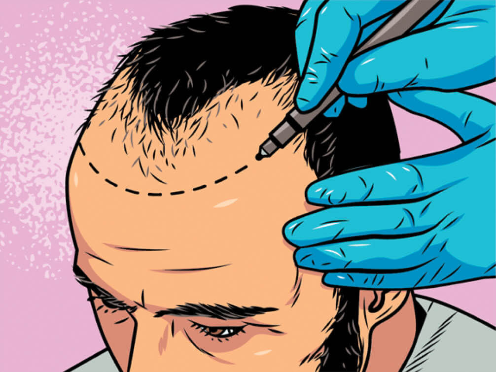 Illustration of a man having a new hairline drawn on his scalp