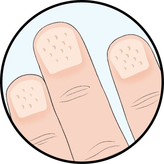 Illustration of fingernails with red-brown lines