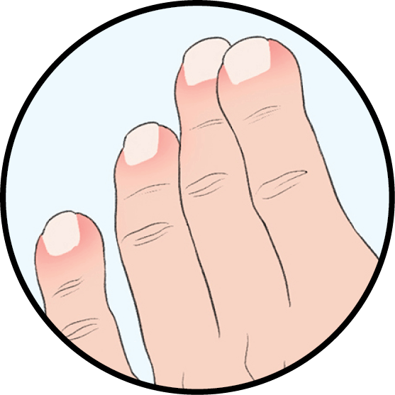 Illustration of swollen fingertips