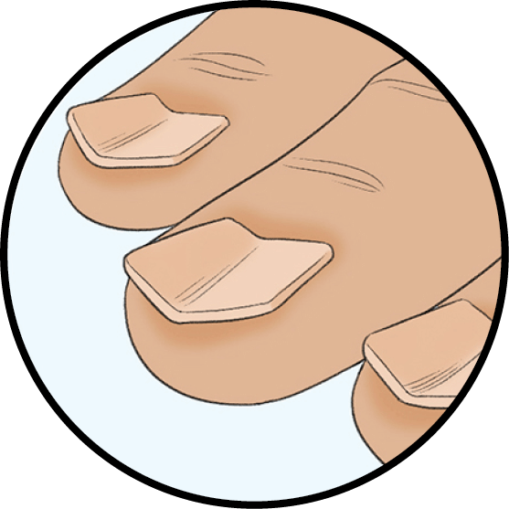 Illustration of fingernails that are raised on the sides