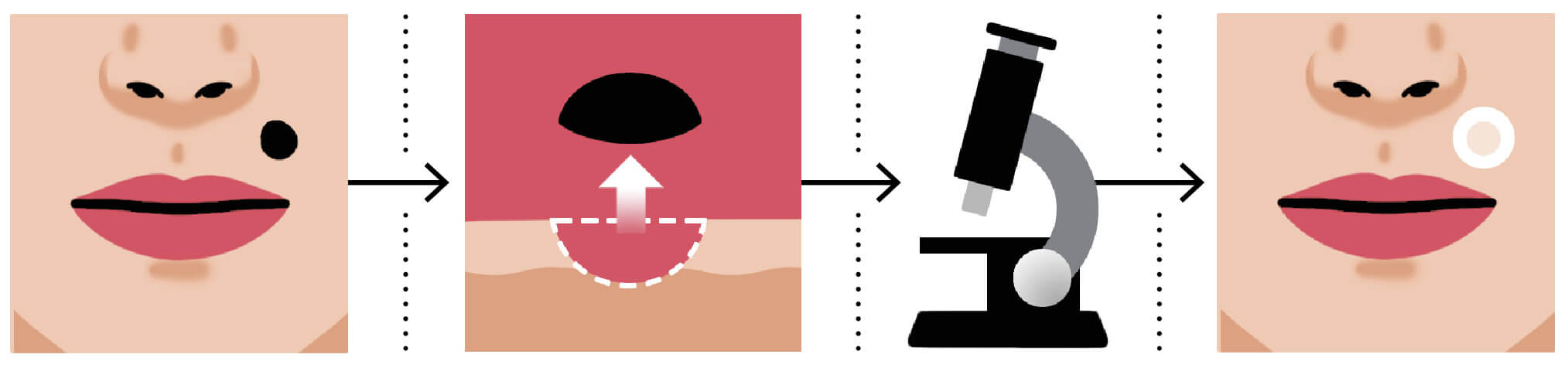 Icon of a mole near a woman's mouth; Icon of a mole being lifted from the skin; Icon of a microscope; Icon of a bandage on the woman's face where the mole was