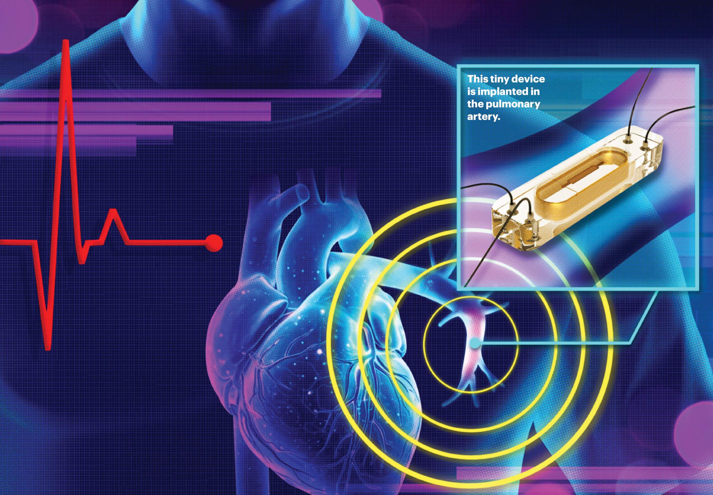 Illustration of a heart with a highlight where a tiny device is place in the pulmonary artery